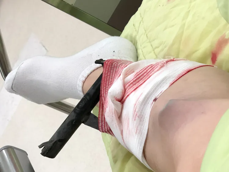 經警消鋸斷中柱、簡易包紮後，將李小姐連人帶中柱送抵大同醫院。讀者提供