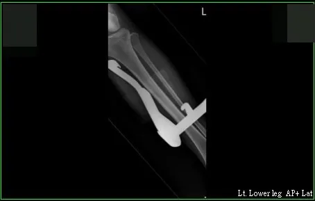 在Ｘ光片影像中，可看到長達23公分的中柱，直直插在李小姐左腿裡。讀者提供