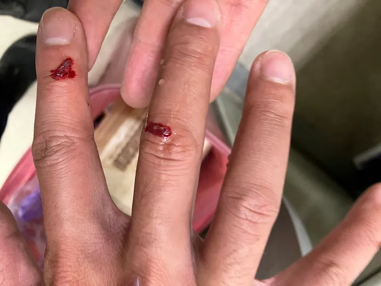 郭姓警員手指多處擦挫傷。翻攝畫面