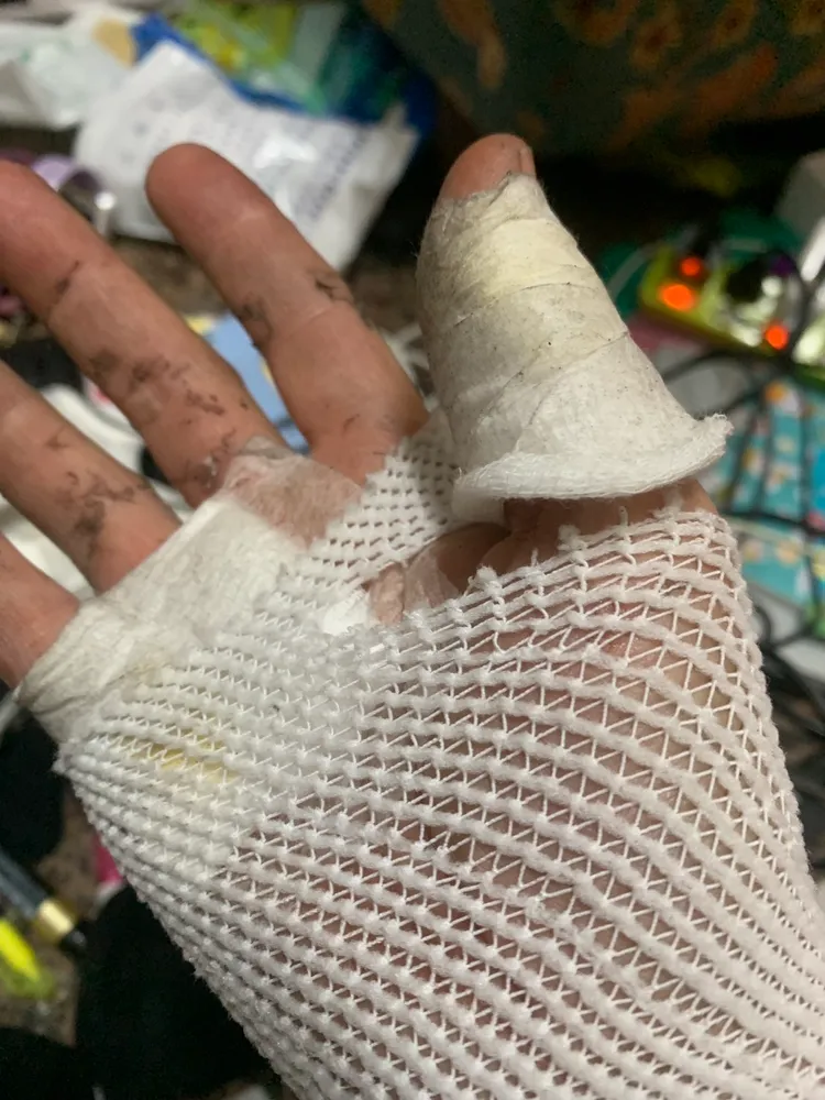 余小姐手掌與手指多處燒燙傷，全是電熱毯惹得禍。民眾提供