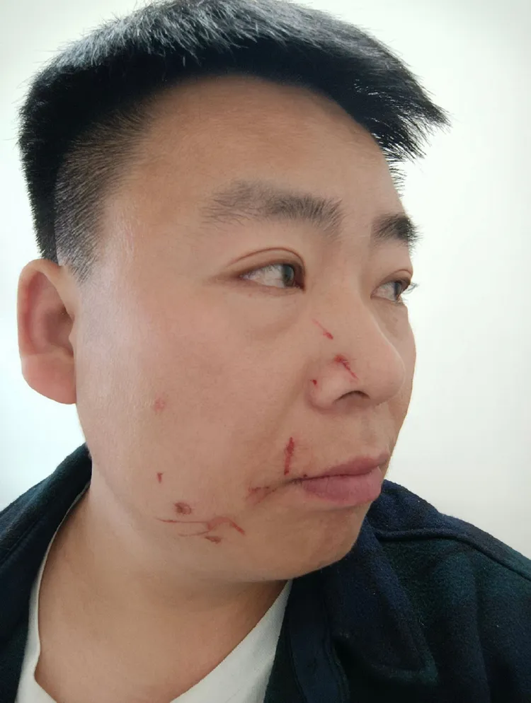 洪亮臉上有傷痕。取自微博