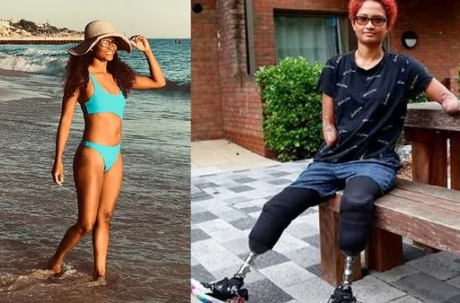 只是被蚊子咬一口　性感女舞者四肢惨遭切除