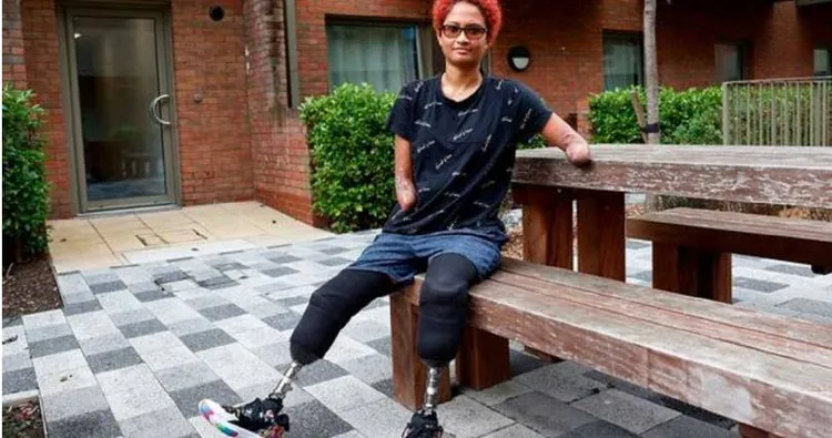 蒂萌清醒後才發現四肢都被切除，她必須重新適應新的人生。翻攝twitter/ Tatiana Timon