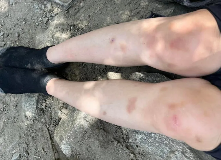 腳部多處瘀青。翻攝自曾格爾臉書