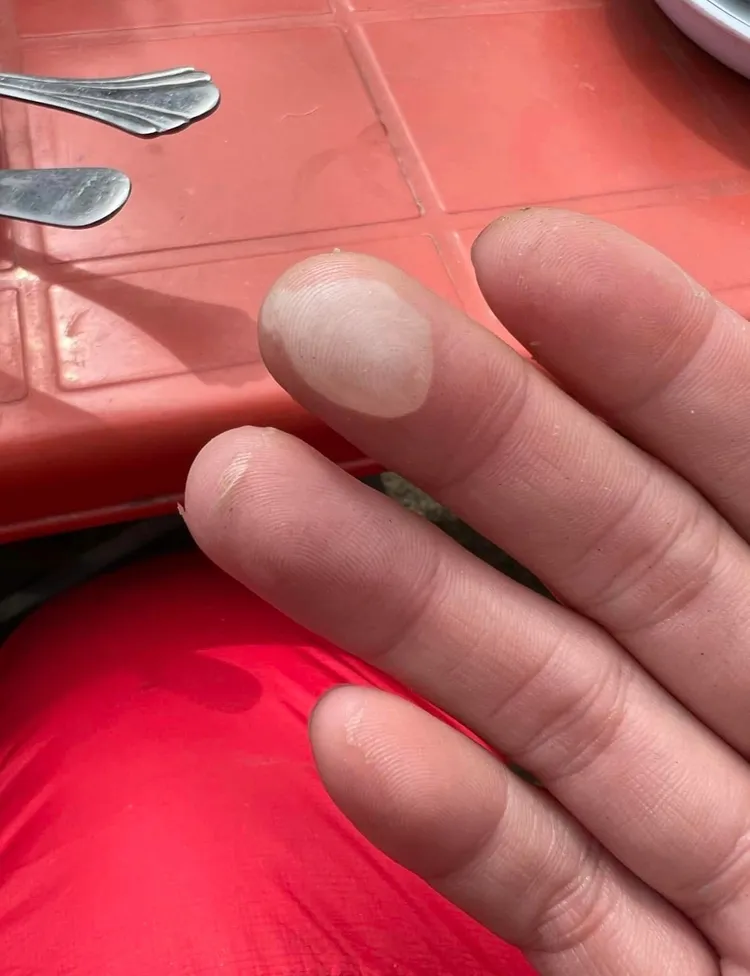 手指反覆長水泡。翻攝自曾格爾臉書