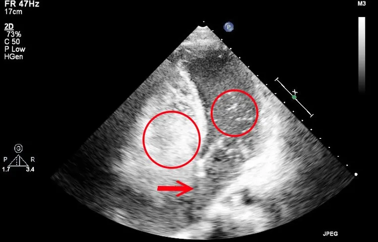 患者氣泡測試超音波顯示，氣泡從阿成右心房中膈缺損(破洞1.5公分)衝到左心房。中國附醫提供