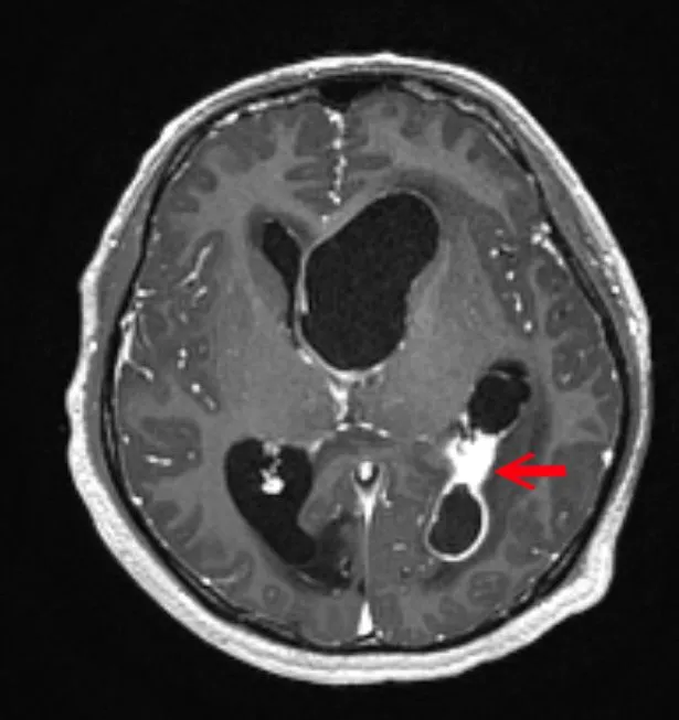 MRI顯影個案阿成的左腦腦膿瘍位置(白色範圍)，水腦會造成對側運動功能受損，由於左腦主管語言，口說理解能力亦會受影響。中國附醫提供