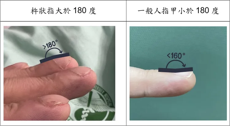 病人阿成因長期缺氧造成杵狀指，呈現手指末端腫脹，指甲從根部到末端呈拱形隆起，讓甲床與指節角度變大，甚至大於180度（圖左）。中國附醫提供