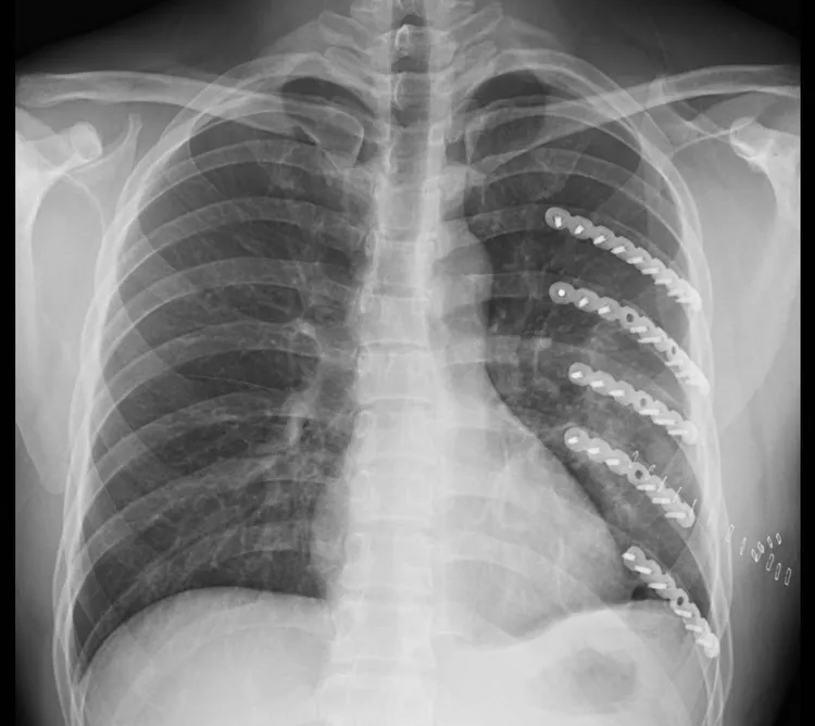 李政錡透過微創肋骨手術後，疼痛感瞬間消失一半。彰化醫院提供