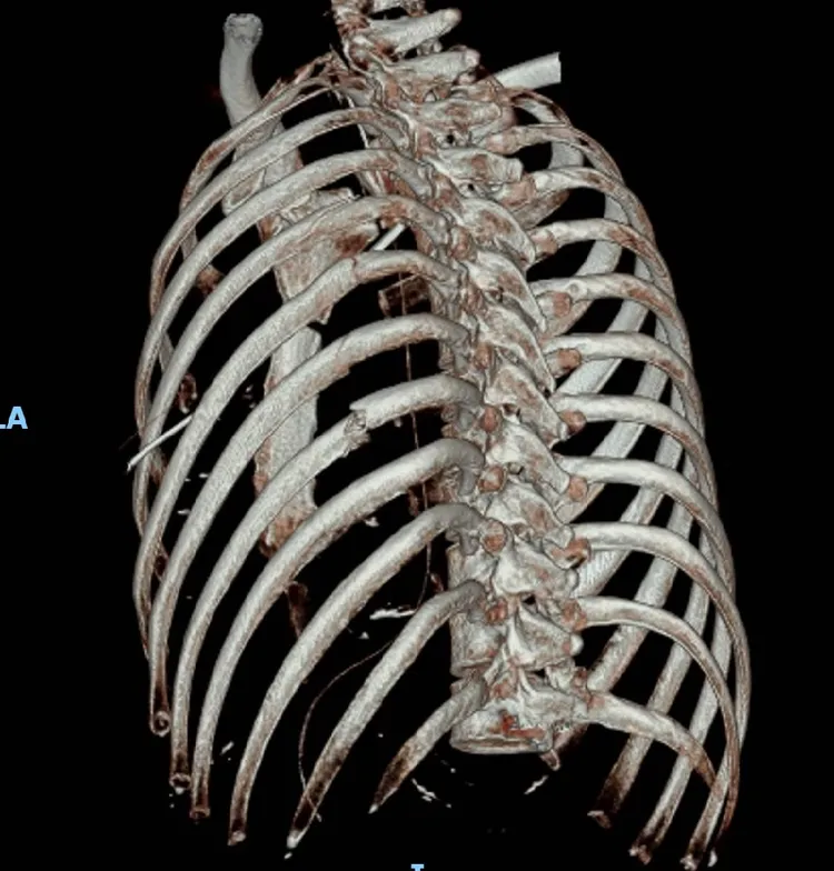 透過3D胸廓重組影像，檢查出李政錡左胸8根肋骨斷裂。彰化醫院提供