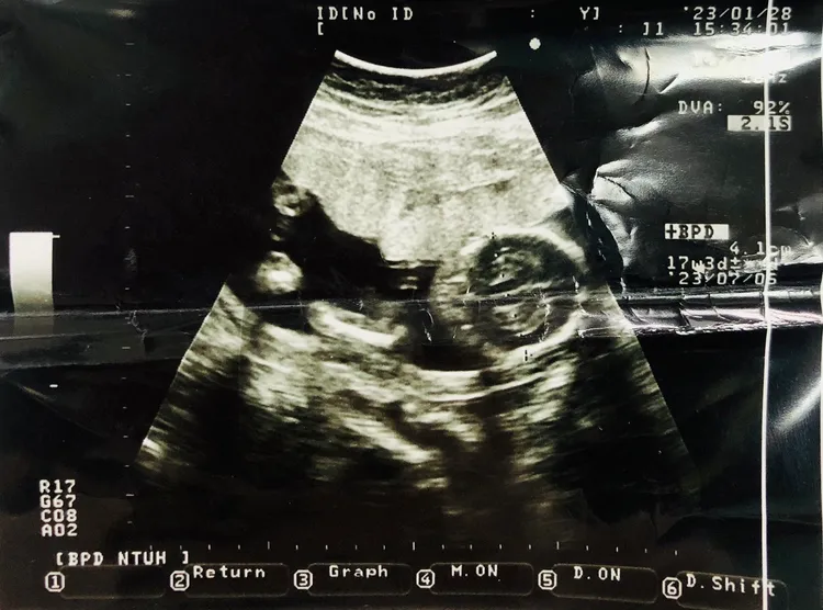 安娜已經懷孕5個月。翻攝畫面