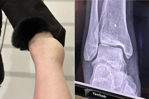 高嘉瑜「麵龜腳」X光片曝光！醫生證實傷到這　聽最糟狀況她嚇哭了