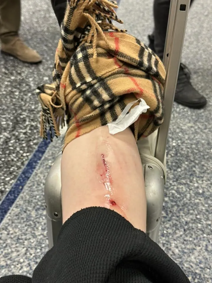 小腿也有一道長傷口見血。取自高嘉瑜臉書