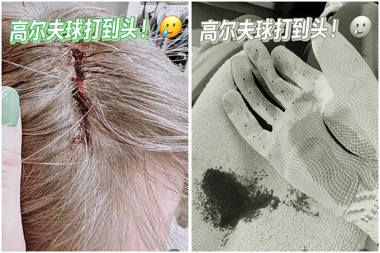 男星孫耀威驚傳遭高爾夫球打到頭的意外，當場鮮血直流。翻攝《孫耀威》小紅書