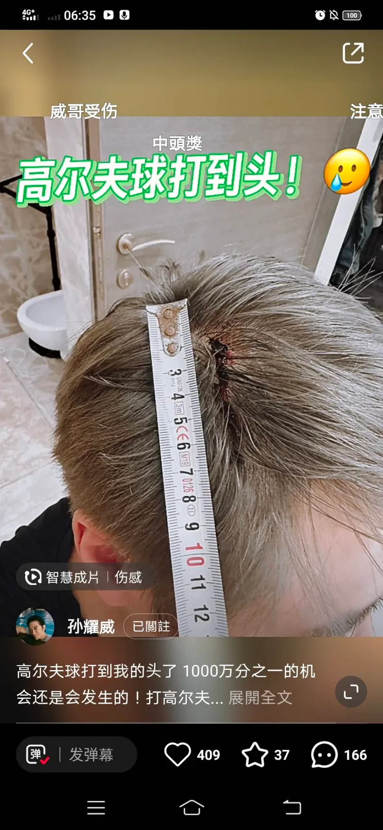 孫耀威遭高爾夫球打到頭的照片，血淋淋傷口長達5公分。翻攝《孫耀威》小紅書