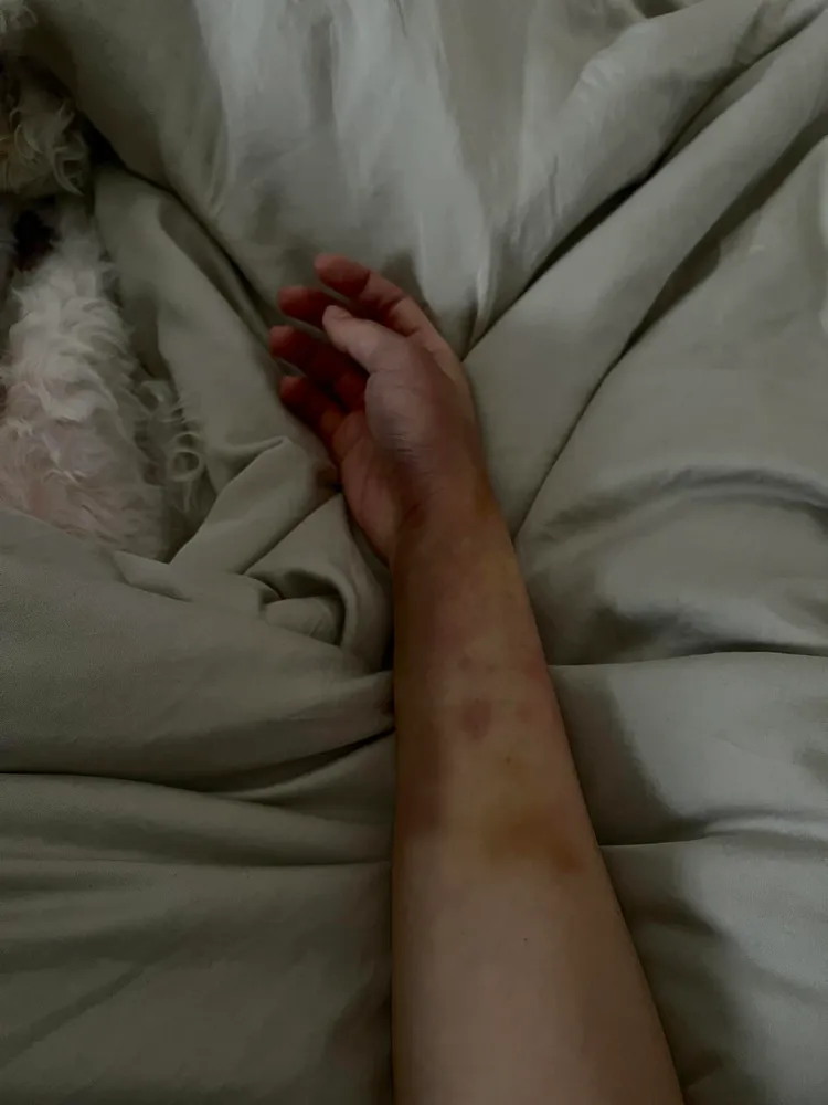 舒子晨打排球導致手瘀青，乍看以為發生意外。翻攝自舒子晨臉書