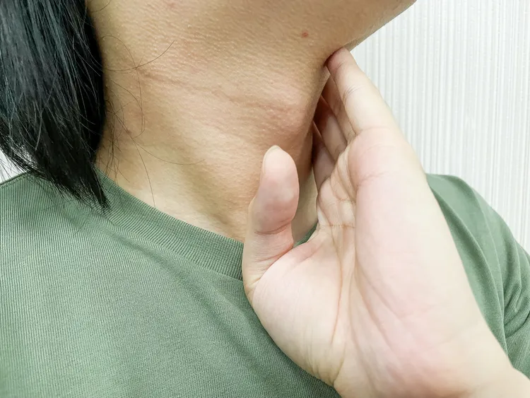 感染HPV引起扁桃腺癌，患者往往先發現脖子的淋巴結腫大。示意圖，賴昀岫攝