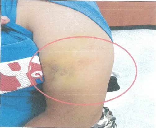 被害人慘遭詐團成員施暴，手臂留下清晰可見的瘀青傷痕。警方提供