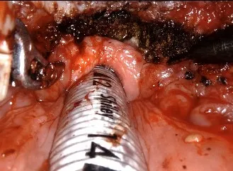 達文西手術切除肥厚的淋巴增生組織。嘉基提供