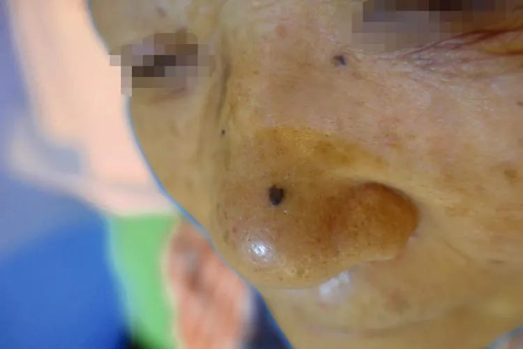 台中市70多歲退休導遊，鼻頭突然出現黑痣，就醫檢查確認罹患「基底細胞癌」。茂盛醫院提供