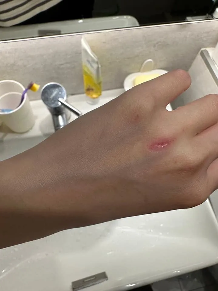 傷口被削去一塊。取自爆料公社