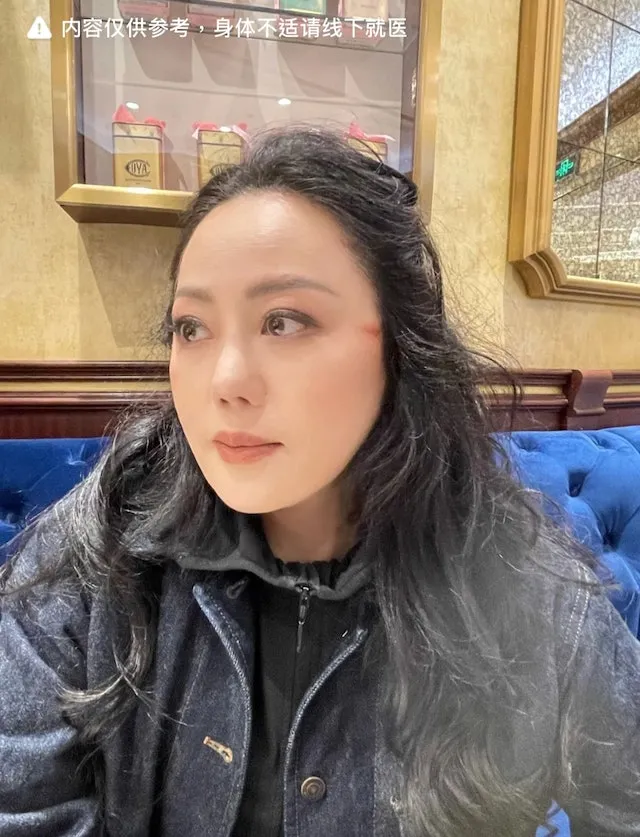 但她近來卻意外在做造型時，被電捲棒燙傷臉。引自章小蕙小紅書