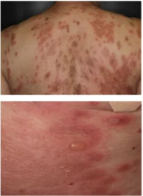 北榮曾收治1名69歲男性患者，皮膚出現搔癢紅疹、出現大小不一的水疱破皮。北榮提供