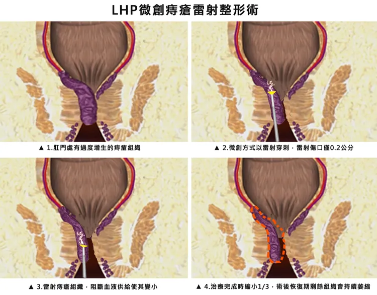 瘡雷射整形手術流程。中港澄清醫院提供