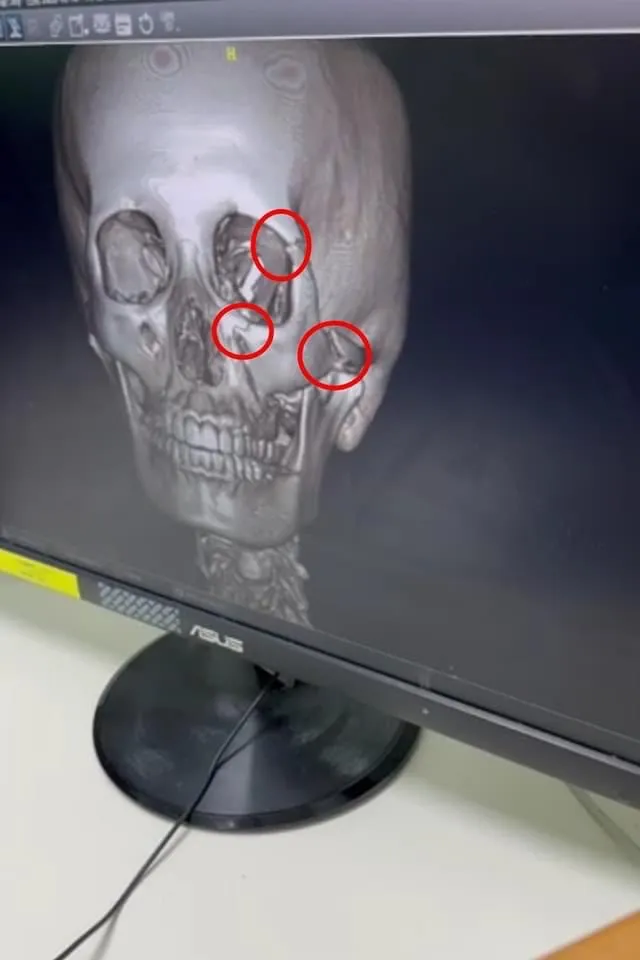 宋燕旻車禍撞擊頭部嚴重腦震盪，頭眼眶也斷。翻攝自宋燕旻臉書