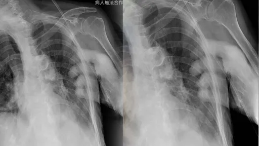 毛到你不行! X光照多出「鬼手」讓重症醫傻眼 專業的給答案了