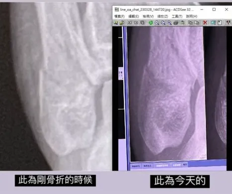 優格姐姐PO出X光片對照圖，兩個月來復原不佳，骨頭沒如預期長好。翻攝優格姐姐IG