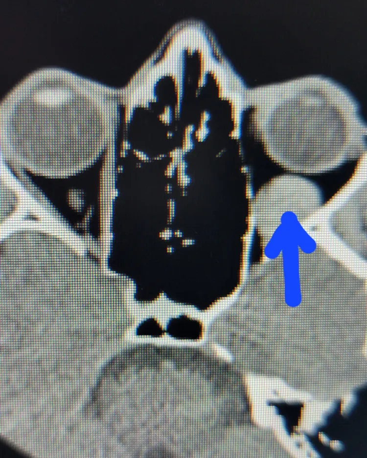 電腦斷層影像可看到陳小姐左眼後方有一塊血塊。讀者提供