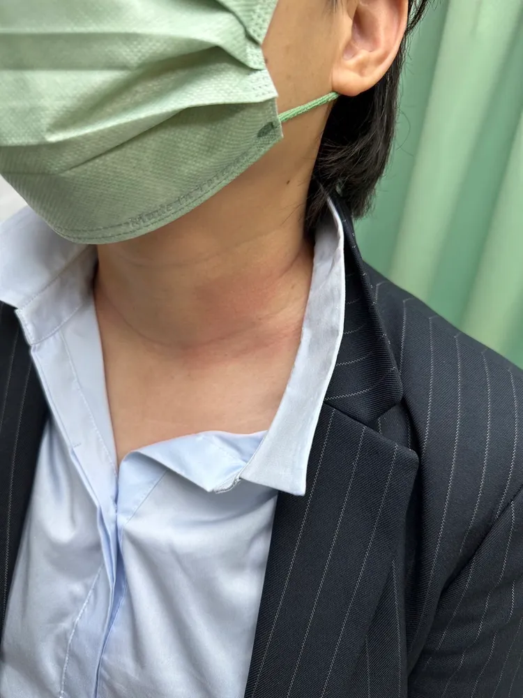 李姓員工被林妍余鎖喉，頸部留下傷痕。李姓員工提供