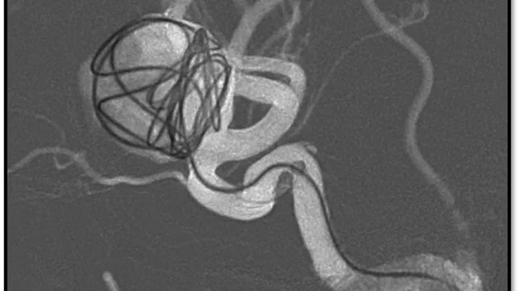 阮郁修醫師以血流導向裝置輔助線圈的方式治療動脈瘤。台北慈濟醫院提供