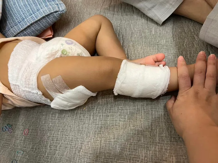 孩童到公園玩竟二度灼傷。翻攝自陳明義臉書