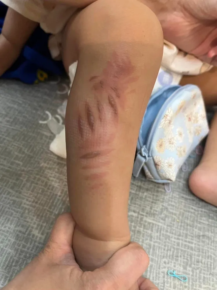 孩童傷勢令人心疼。翻攝自陳明義臉書