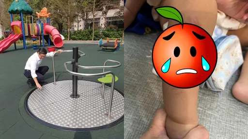 公園「互動轉盤」變烤盤!幼童二度灼傷送急診 網怒太誇張:申請國賠