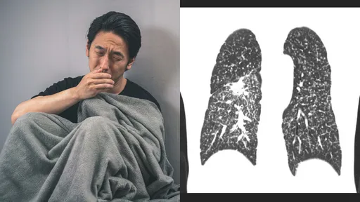 不菸不酒熱愛跑步！他因乾咳加「這點」就診　一查肺癌末期醫嘆：勸也勸不聽