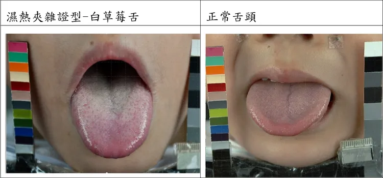 新冠病毒感染後，（圖左）兒童常見舌紅、舌苔白厚膩、舌尖滿布朱點之白草莓舌，顯示體內仍殘留濕熱的表現；圖右為正常舌頭。中國附醫提供