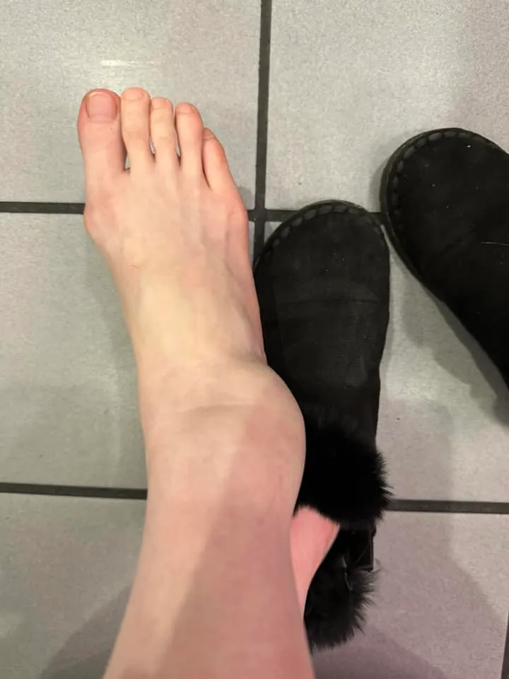 高嘉瑜訪美受傷。取自高嘉瑜臉書