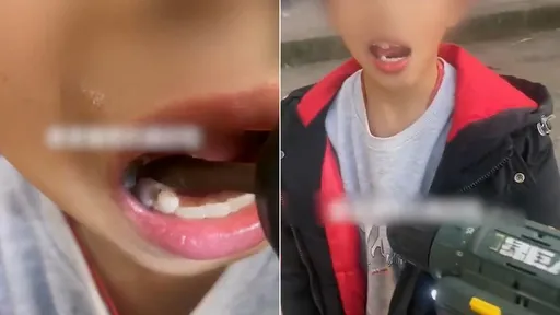 男童牙痛「电钻钻蛀牙」恐怖治疗　老爸出手：这种小事自己就解决了