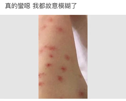 露營被叮出紅豆冰!崩潰跪求防小黑蚊偏方 咖啡渣加這個超獵奇引熱議