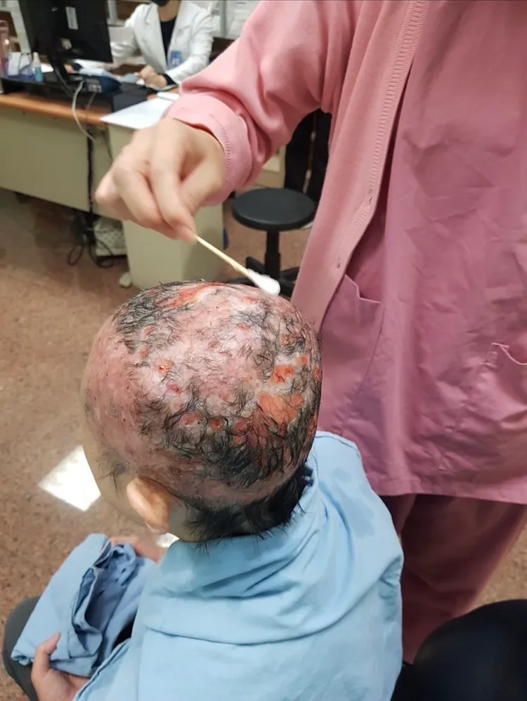 傷口中心團隊以適當敷料減輕患者換藥不適感。中山附醫提供