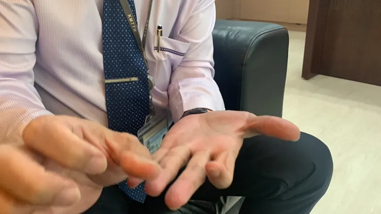 板機指患者常會有手指突然彎曲、伸不直，需另一隻手才能板開的病況。吳慧芬攝