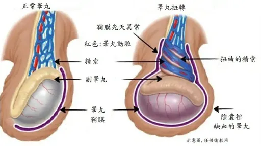 睪丸疼痛別輕忽　開刀驚見紫黑色蛋蛋！超過6小時恐切除