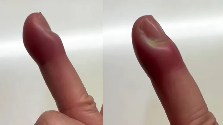 賈靜雯回台找醫生表弟才診斷出是甲溝炎。翻攝賈靜雯IG