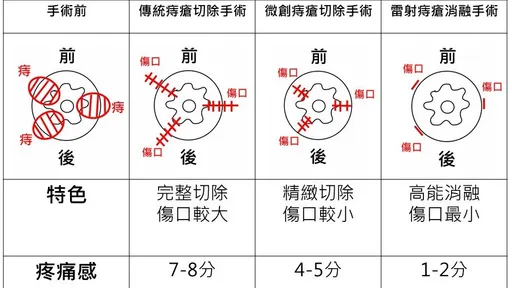 爽吃麻辣鍋竟得「痔」　亞東醫院「雷射消融」還你好肛門