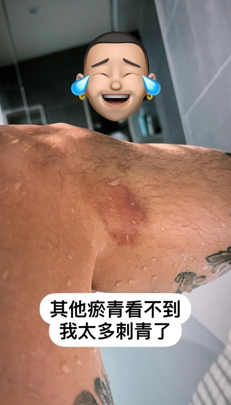 王陽明打到全身瘀青。翻攝王陽明IG