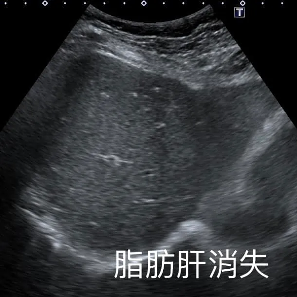 成功減重後婦人脂肪肝症狀完全消失。翻攝自錢政弘臉書