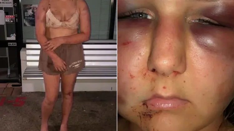 受害少女全身傷痕累累，雙眼周邊被打到瘀青。翻攝自推特